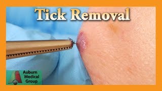 Dead Tick Removal  Auburn Medical Group [upl. by Adabel262]