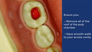 Pulpotomy of Deciduous Molar  QMUL [upl. by Rimidalv]