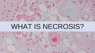 What is Necrosis  Pathology mini tutorial [upl. by Orvah]