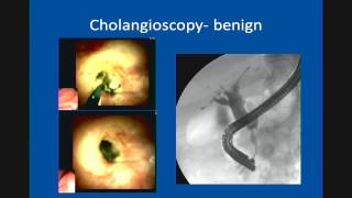 Primary Sclerosing Cholangitis Update in Management [upl. by Scherle]