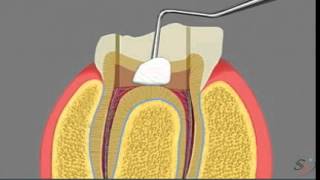 pulpotomy [upl. by Dale]