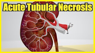 Acute Tubular Necrosis Mnemonic for the USMLE [upl. by Mcgray295]