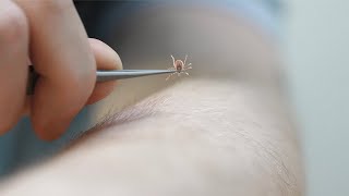 How to properly remove a tick [upl. by Season]